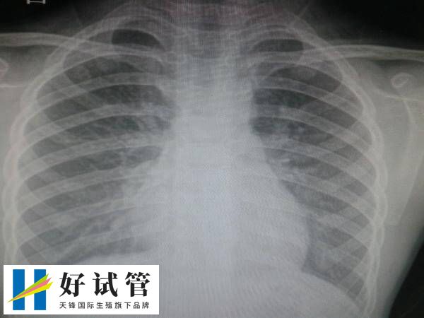 做试管拍胸片是常规体检项目之一