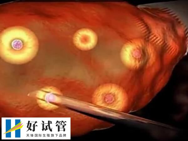 试管取21个左右的卵子是比较理想的