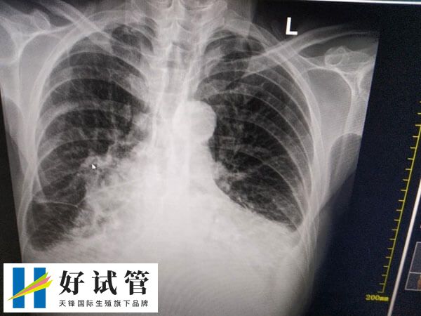 试管移植后出现肩胛骨疼痛可能是激素引起