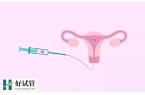 宫腔灌注的流程是什么